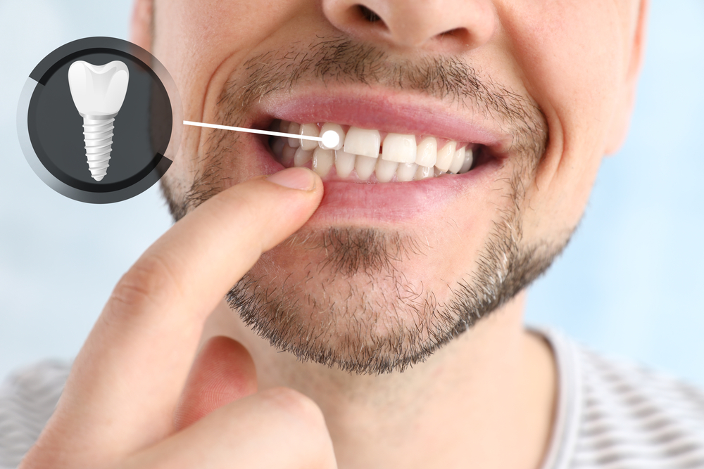 The Step-by-Step Process of Getting Dental Implants